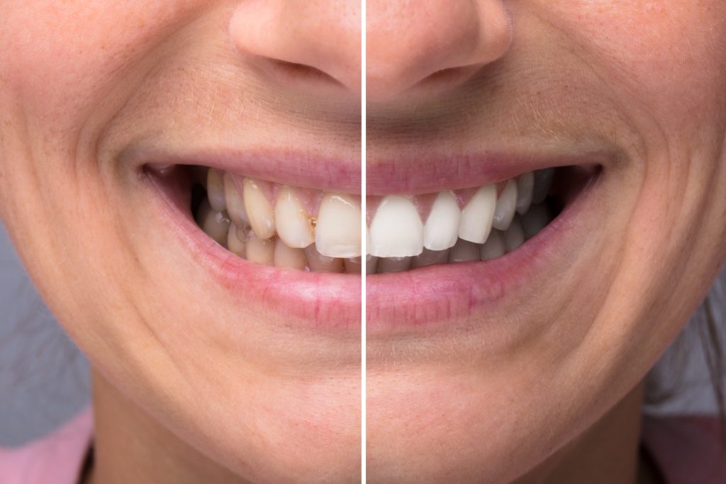 Close-up of enhanced teeth after cosmetic dentistry procedure in Toronto