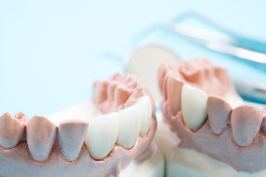 Dental model showing crown and supported bridge at Dental Arts Toronto