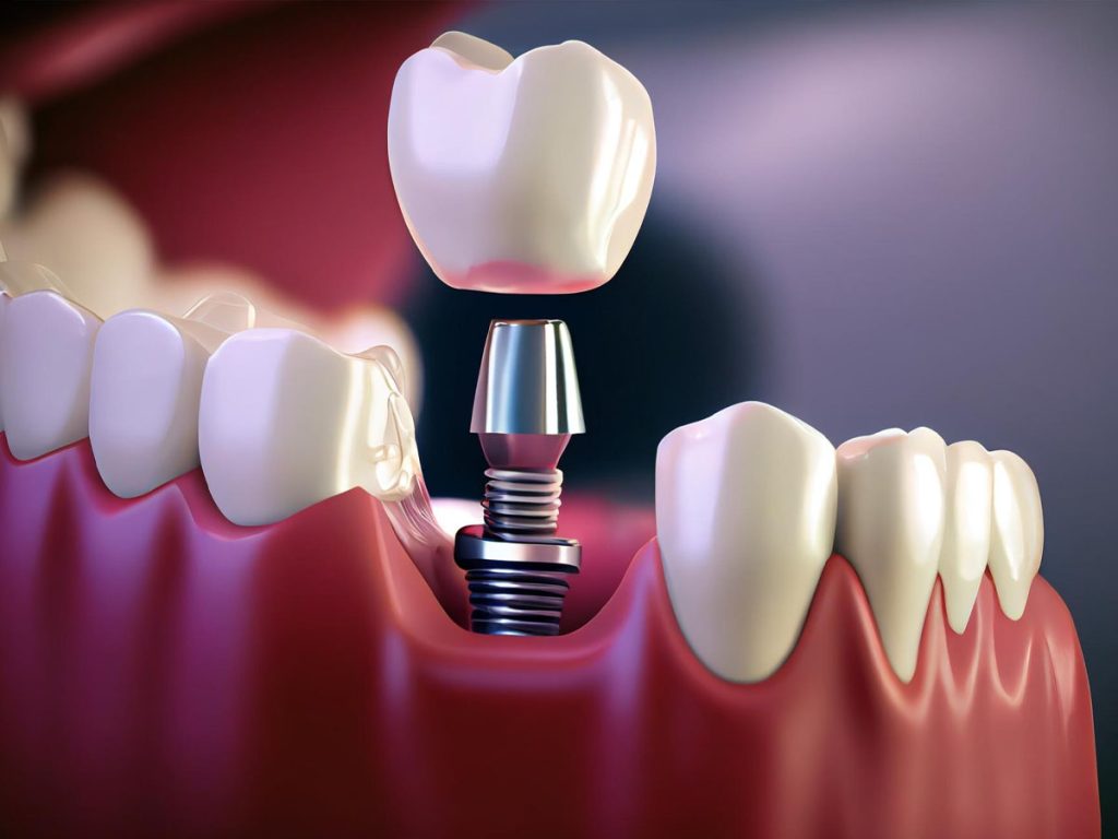 3D view of dental implant screw anchored in jawbone with crown at Dental Arts Toronto