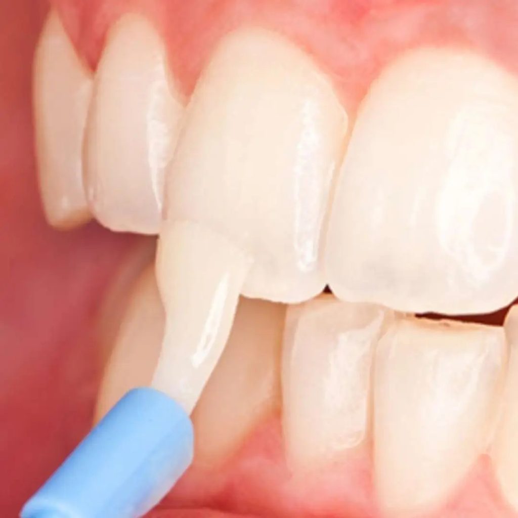 Tooth with fluoride varnish applied using a soft dental brush preventive dental care in Toronto.