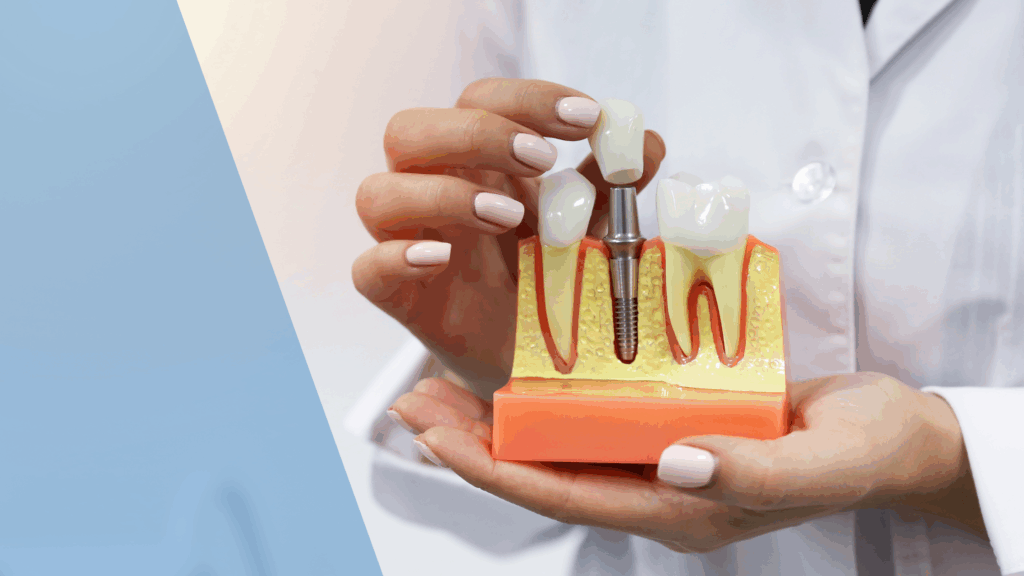 dental implants Dental Arts Toronto preventing jawbone deterioration