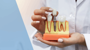 dental implants Dental Arts Toronto preventing jawbone deterioration