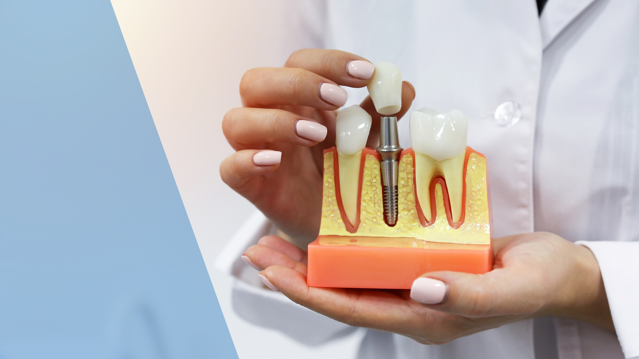 dental implants Dental Arts Toronto preventing jawbone deterioration