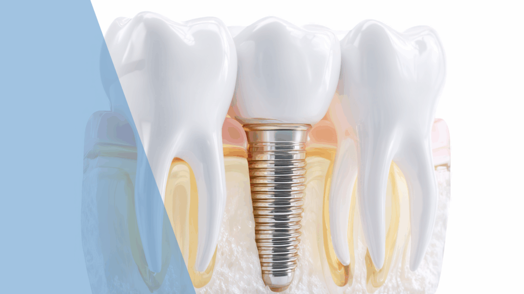 Dental implants comparison chart showing benefits at Dental Arts Toronto