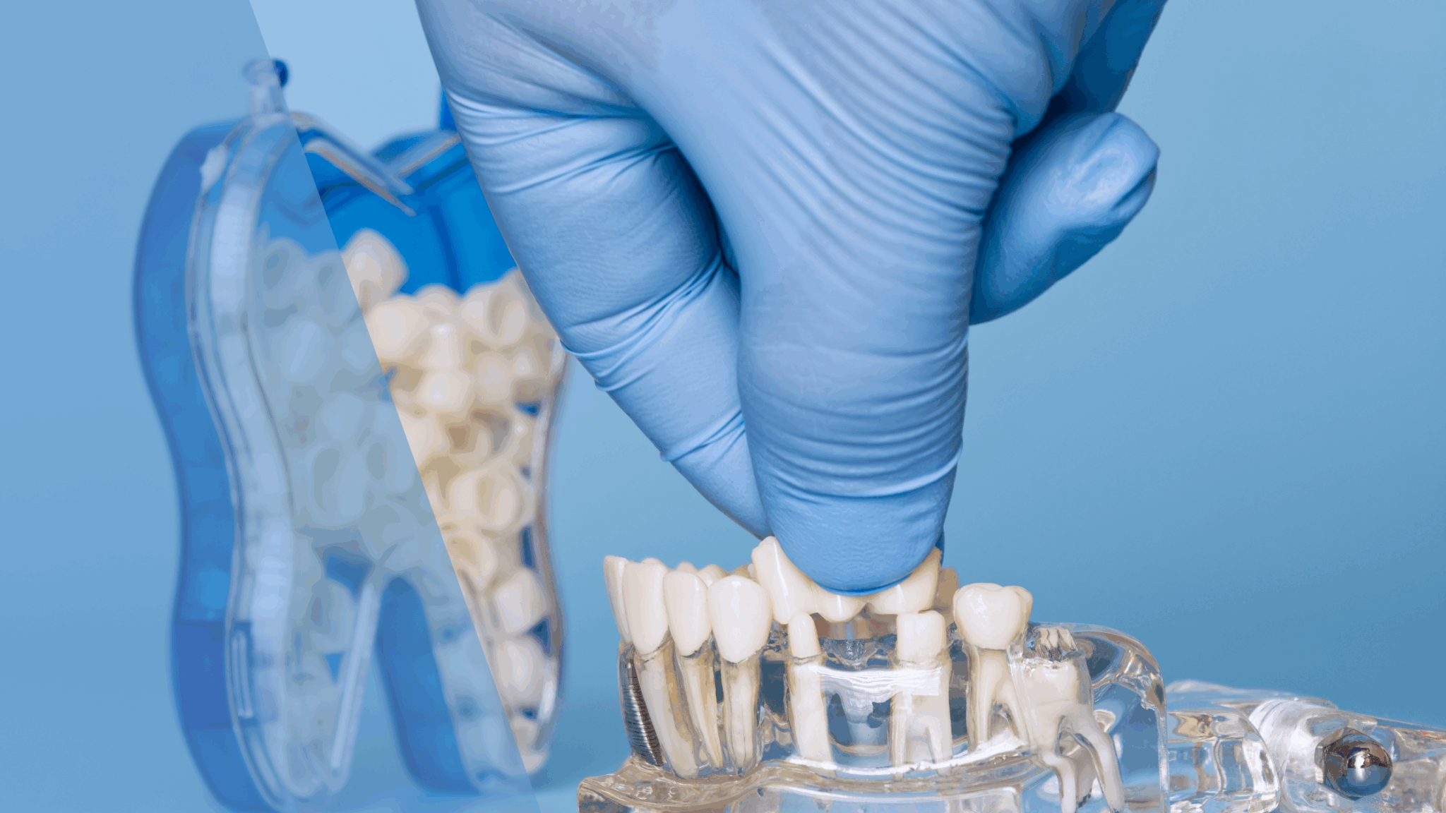 Dentist in Uptown Toronto: Dental Bridges for Replacing Missing Teeth
