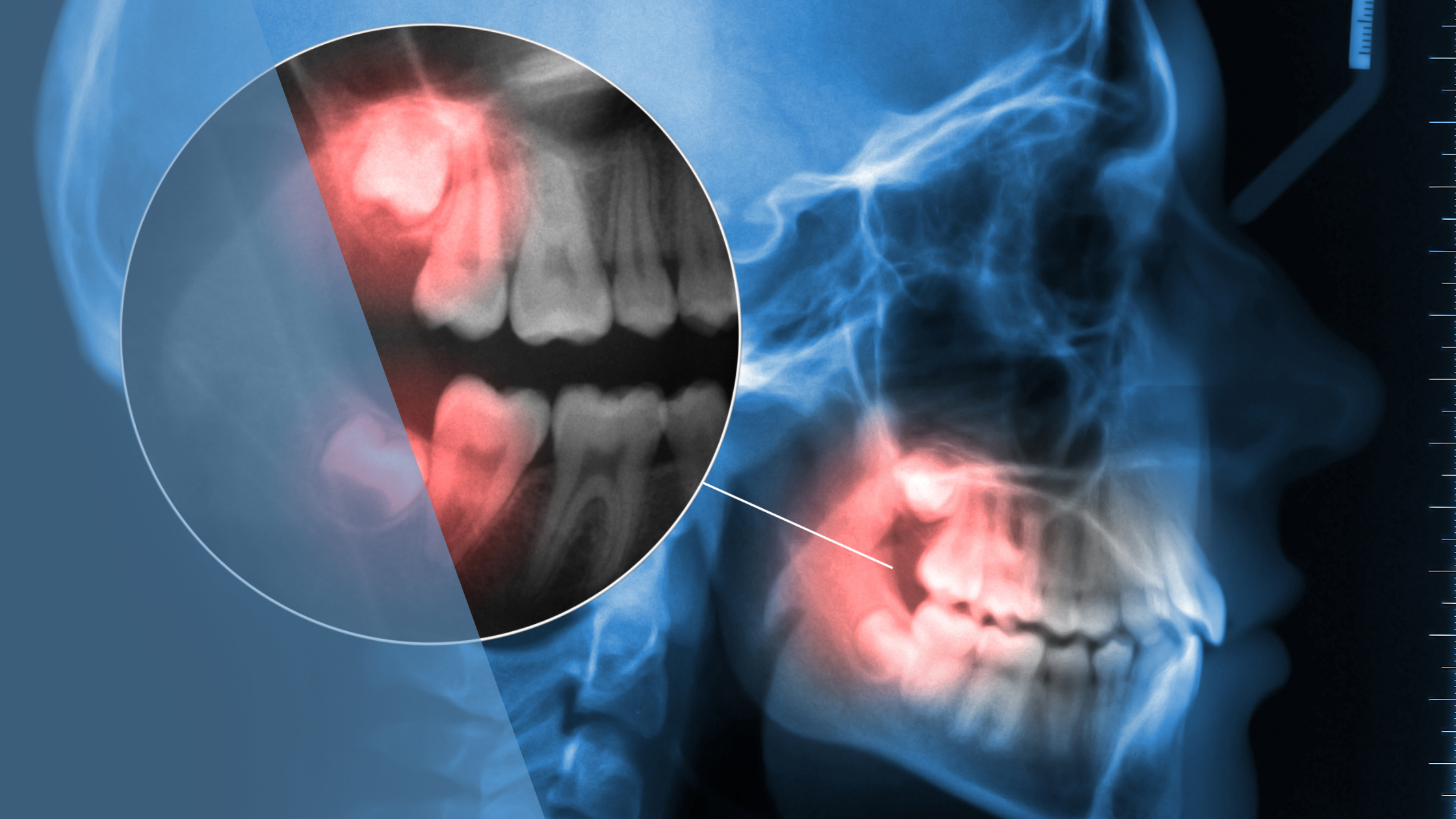 wisdom teeth extractions Dental Arts Toronto recovery timeline guidance