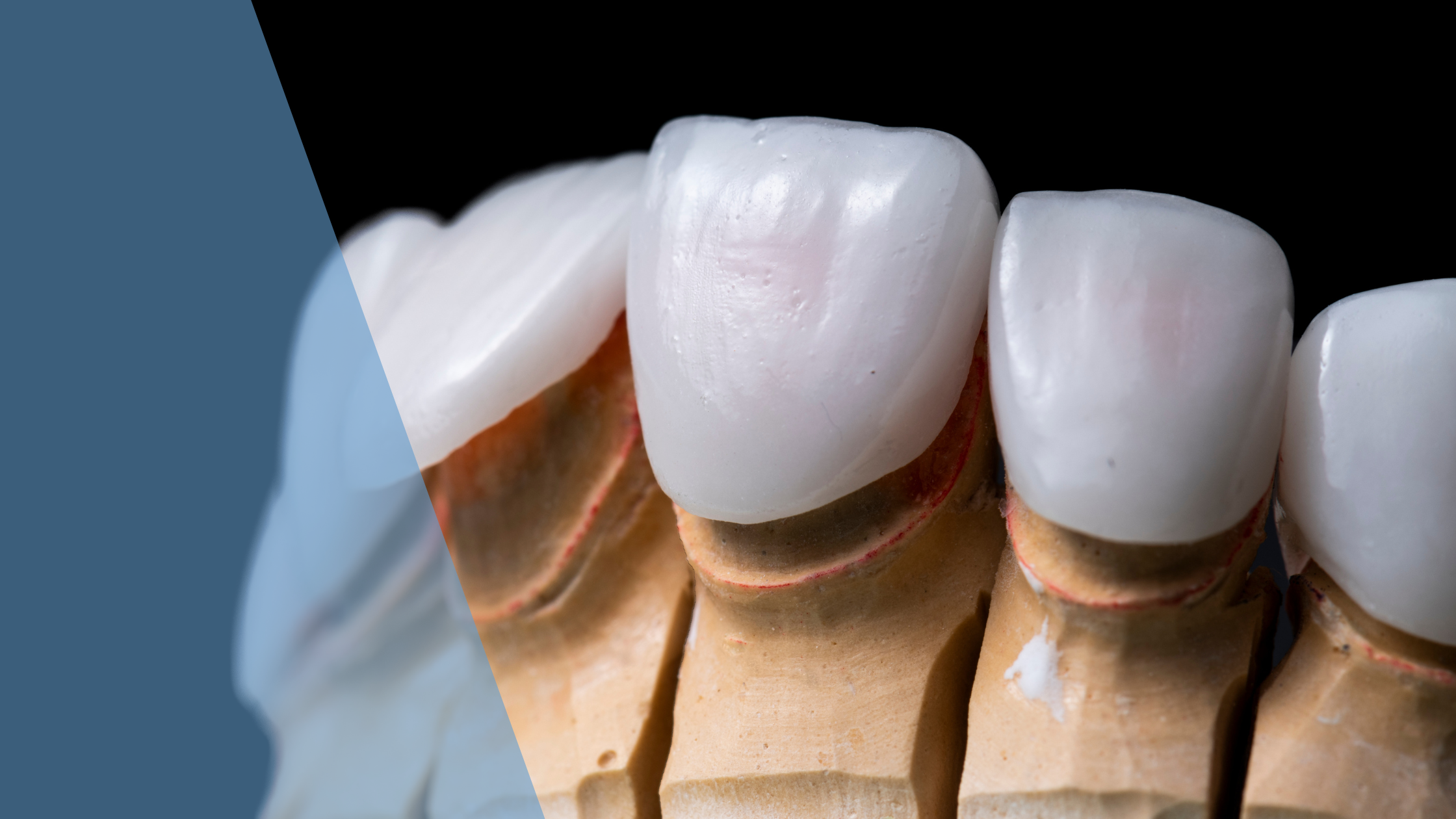 Dentist in downtown Toronto porcelain veneers consultation and digital smile design at Dental Arts Toronto