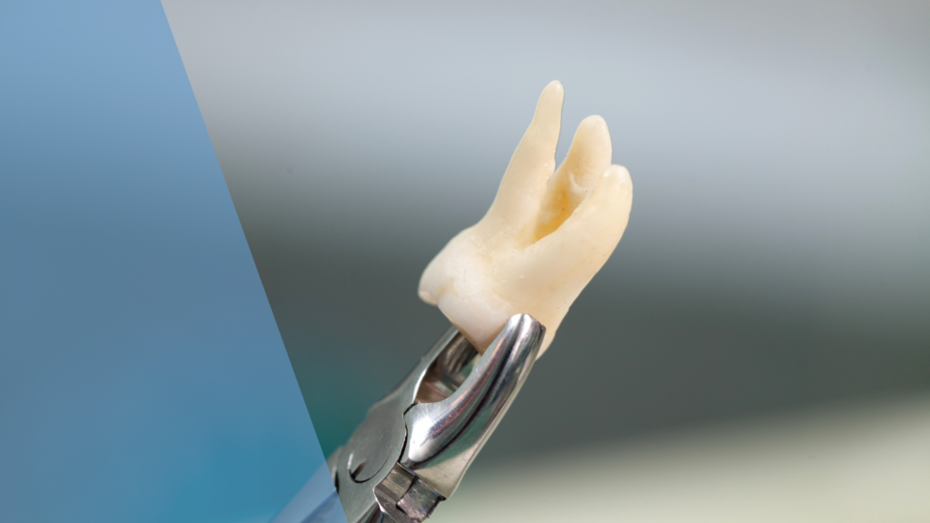 Wisdom teeth extractions procedure guide and recovery timeline at Dental Arts Toronto