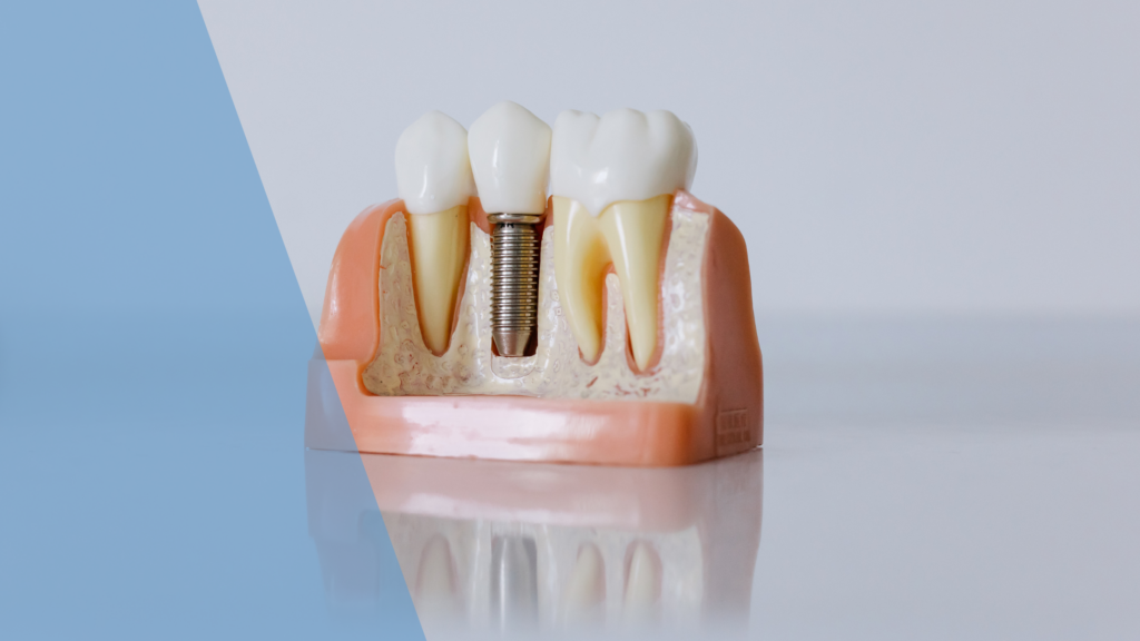 dental implants consultation at Dental Arts Toronto