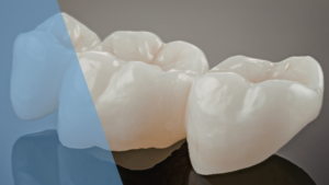 Emergency dentist downtown Toronto treating lost filling and crown at Dental Arts At Front