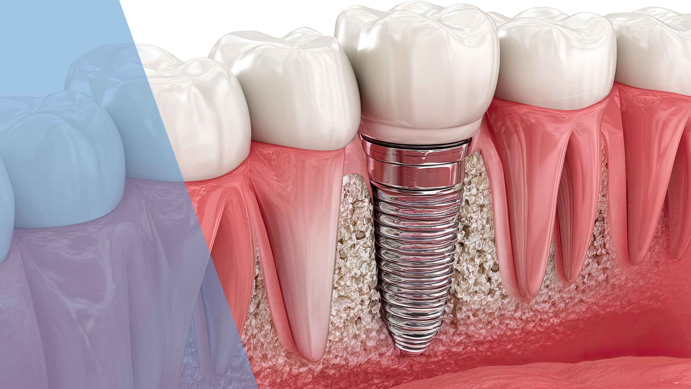 Immediate load dental implants same-day teeth replacement at Dental Arts At Front Toronto