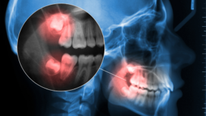 Wisdom teeth extractions nerve proximity assessment using 3D imaging at Dental Arts Toronto downtown Toronto