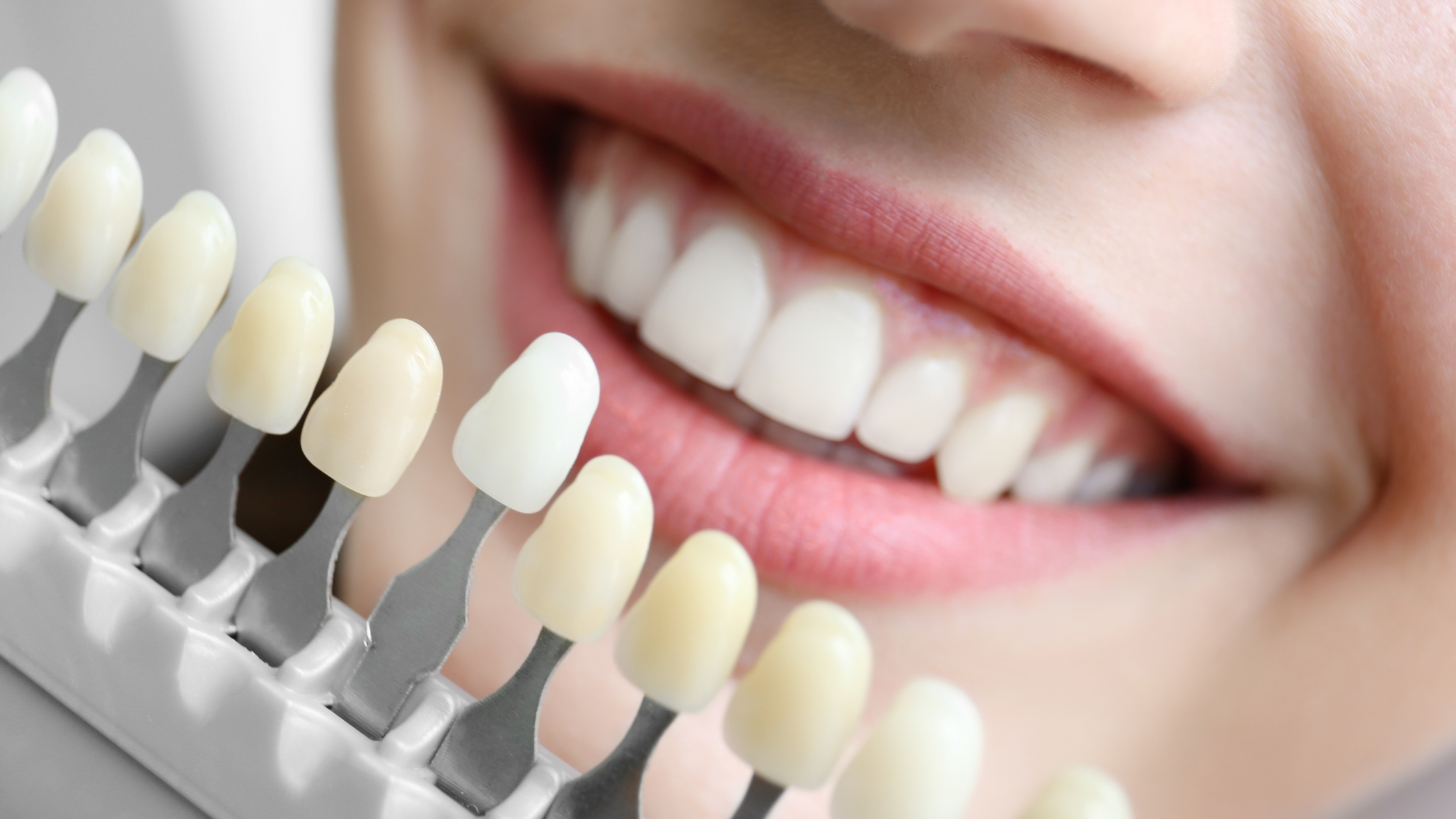 Dentistry in Uptown Toronto porcelain veneers cosmetic treatment, Dental Arts Toronto Lawrence Ave