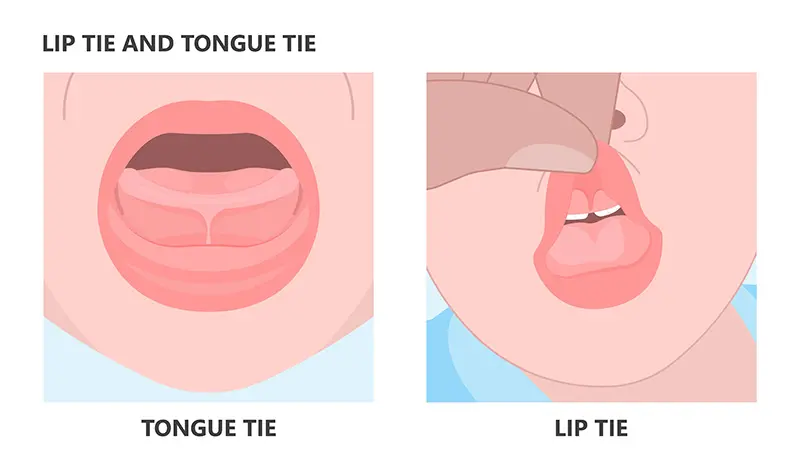 tongue tie treatment in Toronto at Dental Arts Toronto